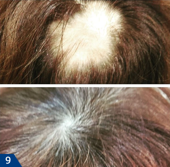 Мезотерапия для волос фото до и после (взято с сайта компании Мезофарм www.mesopharm.ru)
