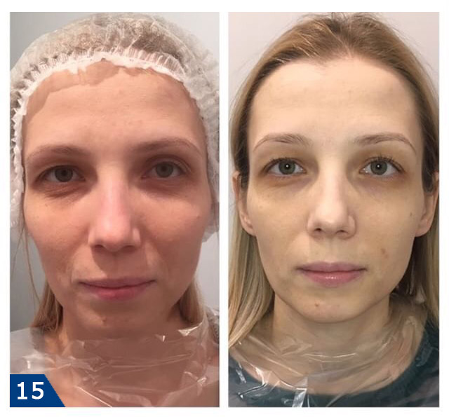 Мезотерапия фото до и после (взято с сайта компании Мезофарм www.mesopharm.ru)