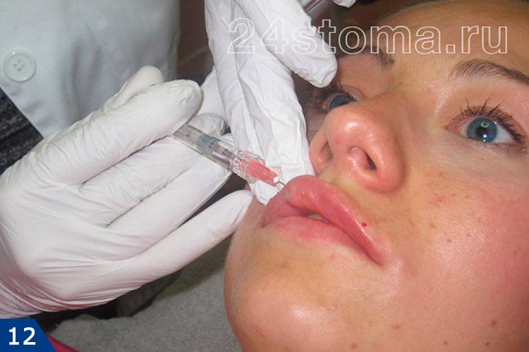 Инъекция внутрикожного наполнителя в губы