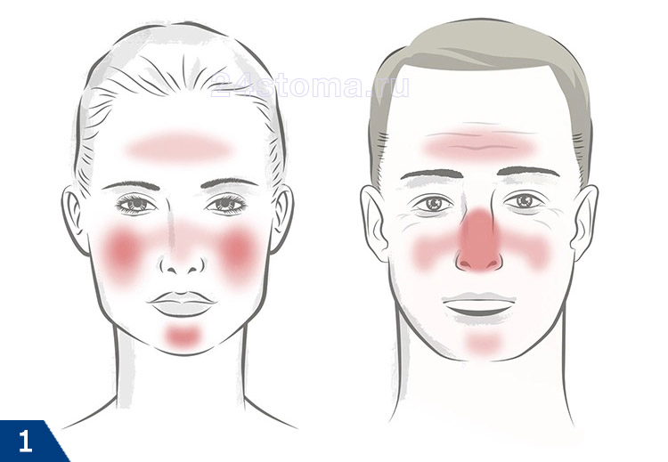 Розацеа на лице: причины и лечение, фото до и после, препараты
