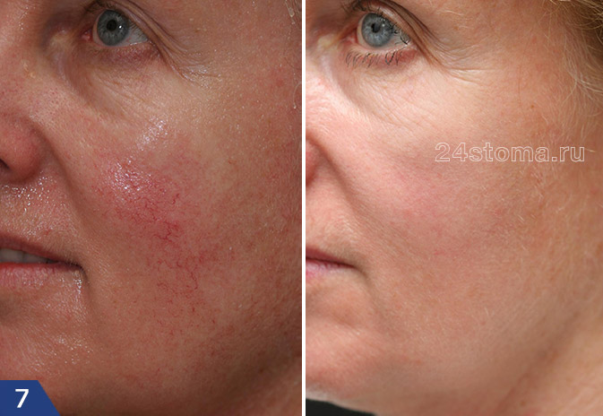 Фото до и после лечения телеангиэктазий лазером на красителях