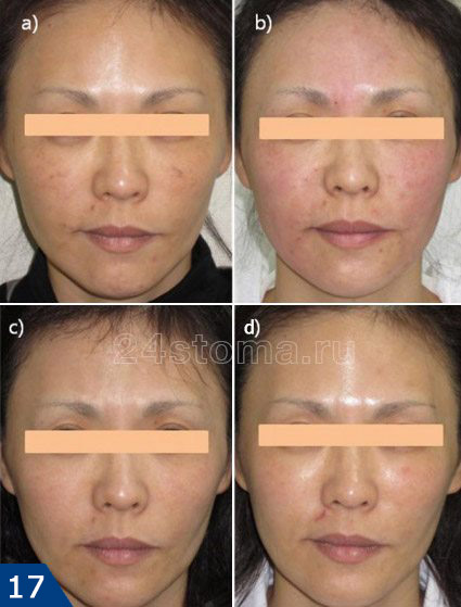 Тредлифтинг всей поверхности лица (вид спереди); подкожно введено 118 мезонитей... а) фото до операции, b) сразу после операции, c) через 1 месяц, d) через шесть месяцев.