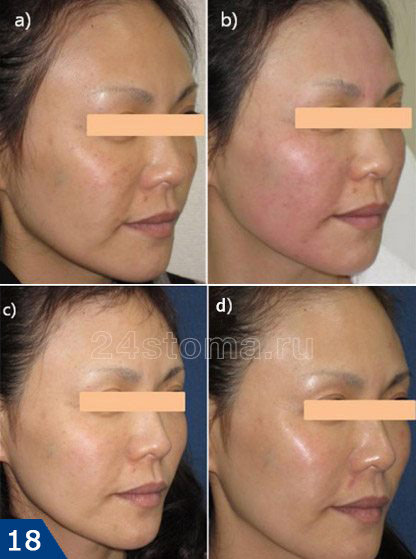 Тредлифтинг всей поверхности лица (вид сбоку); подкожно введено 118 мезонитей... а) фото до операции, b) сразу после операции, c) через 1 месяц, d) через 6 месяцев.