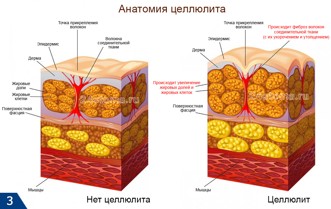 Анатомия целлюлита (с одной стороны происходит увеличение жировых клеток и долей, а с другой - укорочение и утолщение перегородок их соединительно-тканных волокон; как результат - симптом апельсиновой корки)