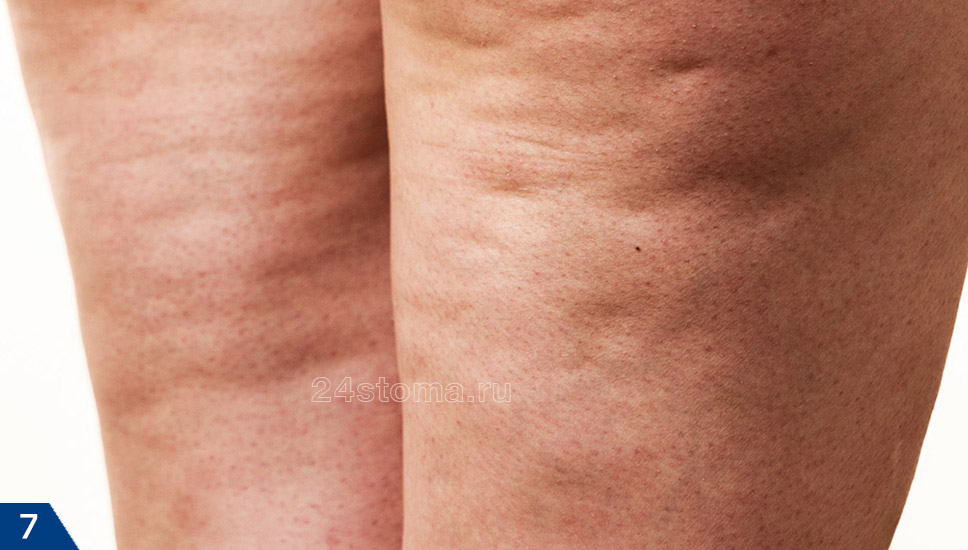 4 стадия целлюлита (на коже присутствует бугристость, ямочки, что говорит о явлениях склероза соединительно-тканных волокон))