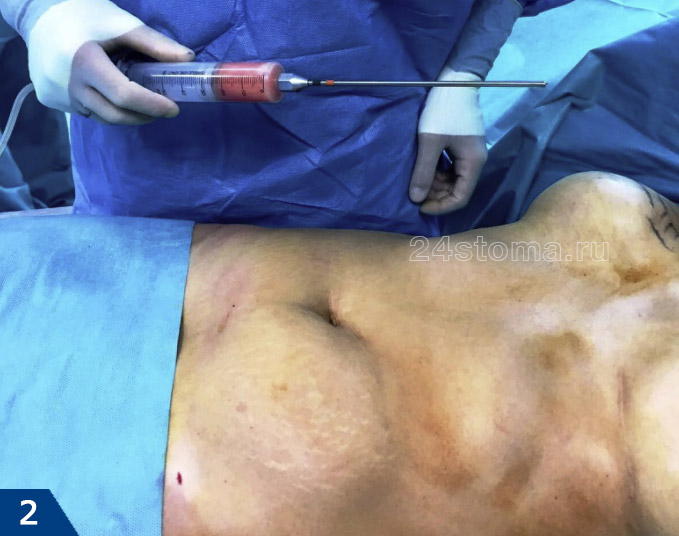 Липосакция на животе (в руках у хирурга большой шприц с полой канюлей, подключенный к вакуумному аспиратору)