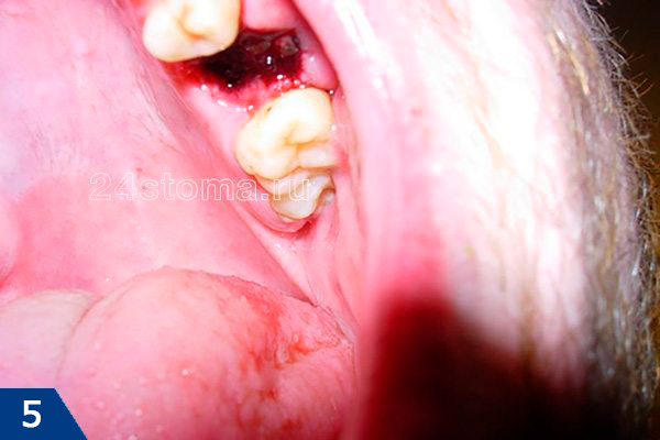 Вид лунки удаленного зуба сразу после того, как был убран марлевый тампон (спустя 20 минут после удаления)