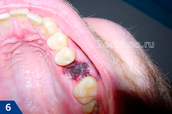 Вид лунки удаленного зуба через 3 дня после удаления