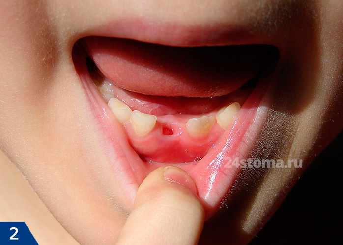 Выпал молочный зуб (наблюдается задержка прорезывания одного центрального нижнего резца)