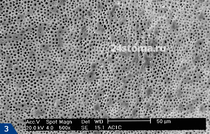 Электронная микроскопия: поверхность деминерализованного дентина, испещренная канальцами