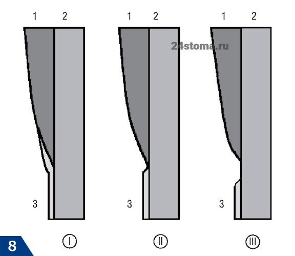 Варианты эмалево-цементной границы (схема)