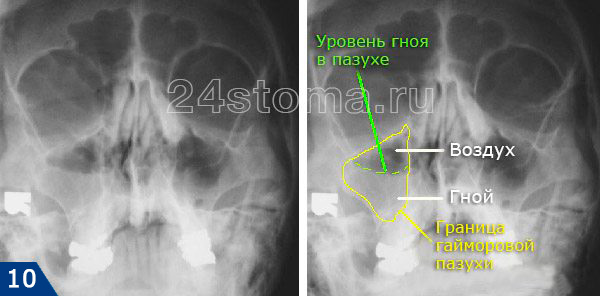 Вид острого гнойного верхнечелюстного синусита на рентгеновском снимке (хорошо виден уровень гноя в пазухе)