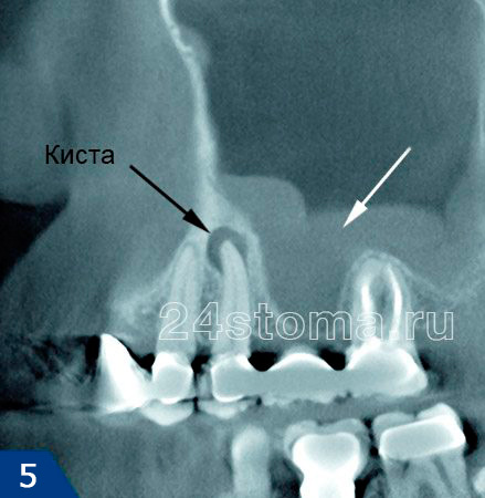 Одонтогенный гайморит: на верхушке корня 5-го зуба киста; в области дна гайморовой пазухе гной/полипы.