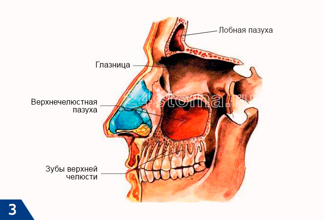 Схема расположения верхнечелюстных пазух (верно для каждой из половин верхней челюсти)