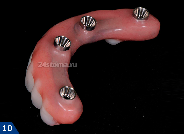 Готовый временный несъемный зубной протез на 4 имплантах. Обратите внимание на, что в протез встроена система винтовой фиксации к имплантам, а также под пластмассой просвечивает металлический каркас.