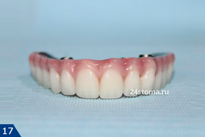 Постоянный несъемный зубной протез All-on-4, выполненный с использованием титановой балки и акриловой пластмассы
