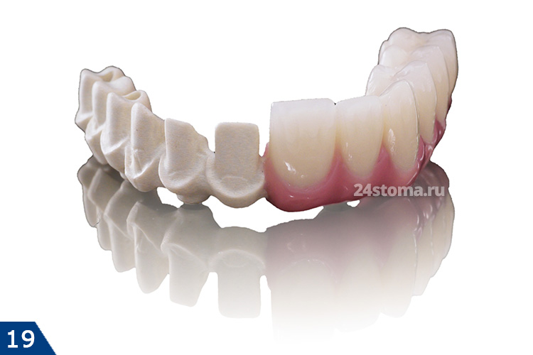 Каркас мостовидного протеза из диоксида циркония - наполовину облицованный керамическими зубами (искусственная красная десна также выполнена из керамики)