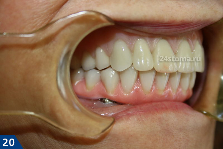 Несъемный постоянный мостовидный протез из диоксида циркония (нижняя челюсть)