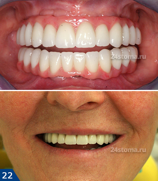 Протезирование зубов Алл-он-4 (верхняя и нижняя челюсти). Постоянные несъемные протезы на 4 имплантах, выполненные на титановой балке с использованием акриловой пластмассы.