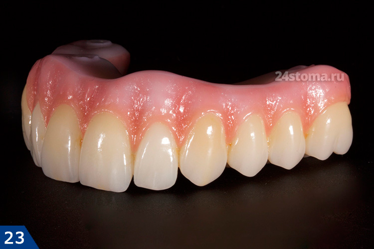 Протезирование Алл-он-4 (несъемный зубной протез на верхнюю челюсть, выполненный из керамики "Prettau" (с фиксацией на 4 имплантах)