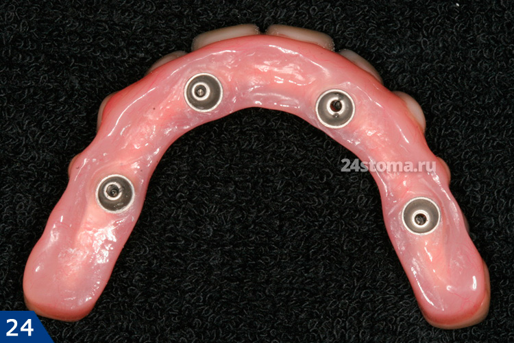 Ошибка зубного техника : вогнутая нижняя поверхность протеза . Это приведет невозможности гигиены нижней поверхности протеза и развитию периимплантита