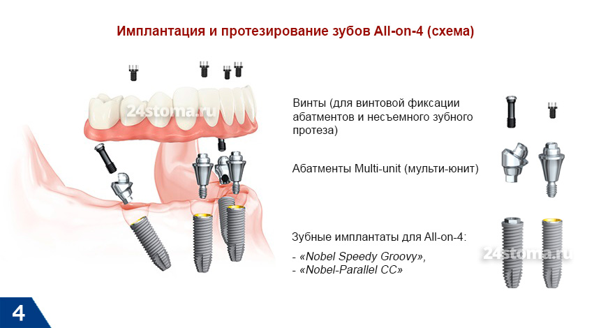 Схема имплантации и протезирования зубов по методике Алл-он-4