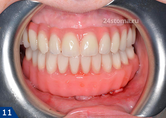 Вид в полости рта. Обратите внимание, что на верхней челюсти пациенту была проведена методика Алл-он-4