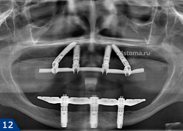 Вид Алл-он-3 (на нижней челюсти) и Алл-он-4 (на верхней челюсти) - на рентгеновском снимке.