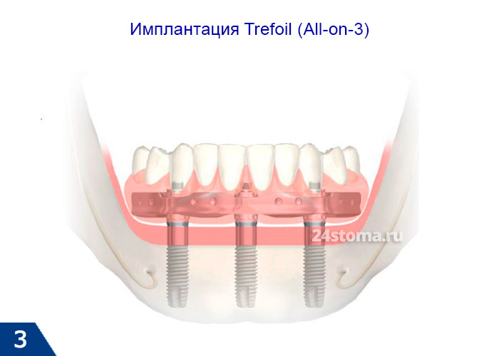 Концепция имплантации Trefoil® (All-on-3)