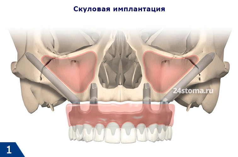 Скуловая имплантация зубов на схеме