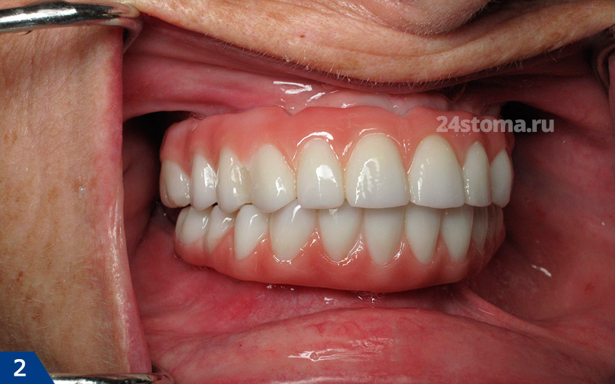 Полностью несъемные зубные протезы с опорой на импланты