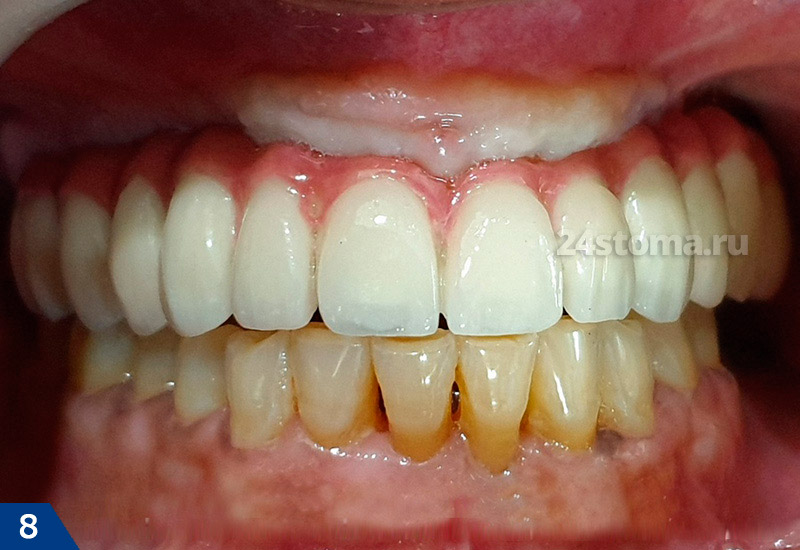 Базальная имплантация зубов (этап постоянного протезирования)
