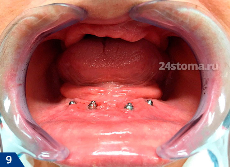 Протезирование зубов на 4 имплантах (установлены 4 импланта с абатментами мульти-юнит)