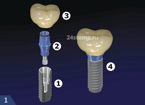 Схема протезирования на импланте: 1 - зубной имплантат, 2 - абатмент (+ винт), 3 - искусственная коронка, 4 - конструкция в сборе.