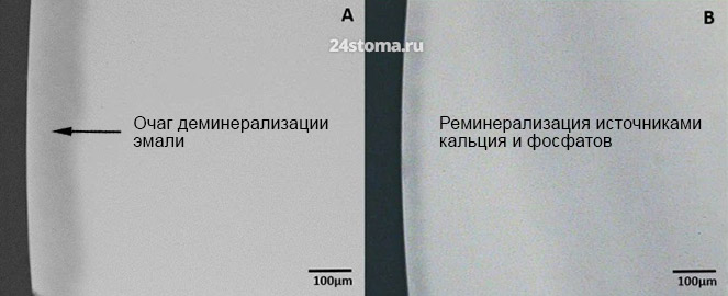 Реминерализация источниками кальция и фосфатов (снимок электронной микроскопии)