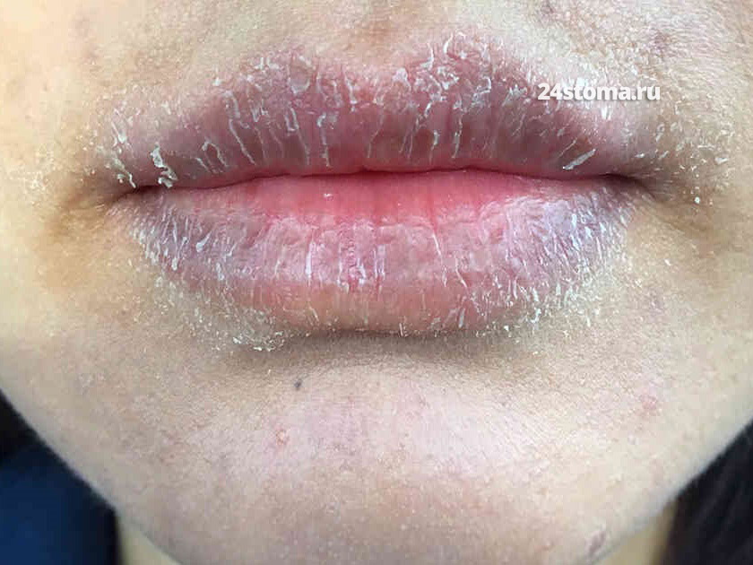 Контактный аллергический хейлит на губную помаду.