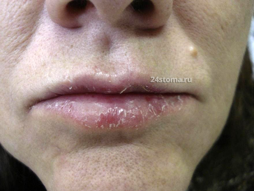 Аллергический контактный хейлит на хлорпромазин (в результате контакта губ с таблетками)