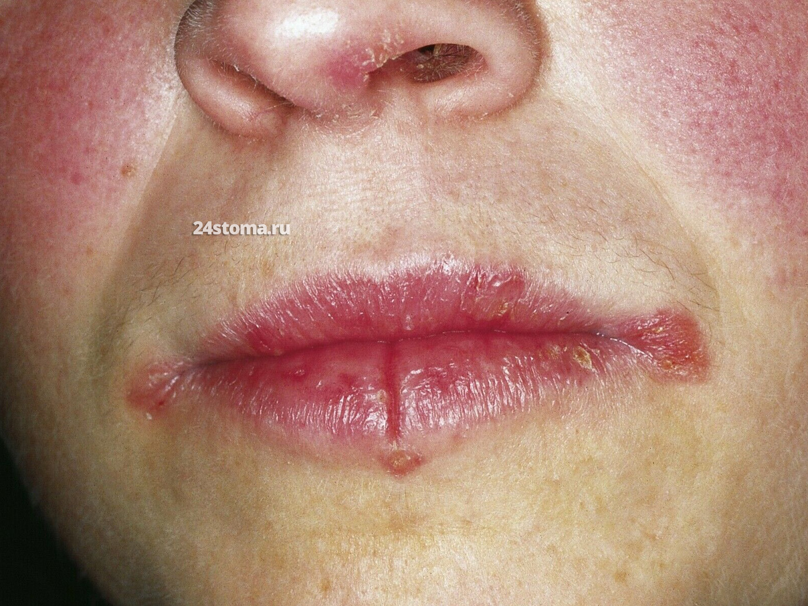 Комбинация заед в углах рта и хронической рецидивирующей трещины по центру нижней губы