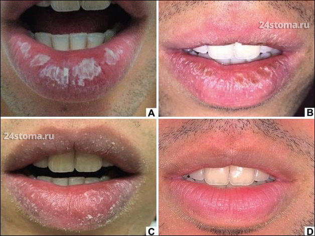 Как изменялись патологические элементы на губах - в процессе лечения кортикостероидной мазью