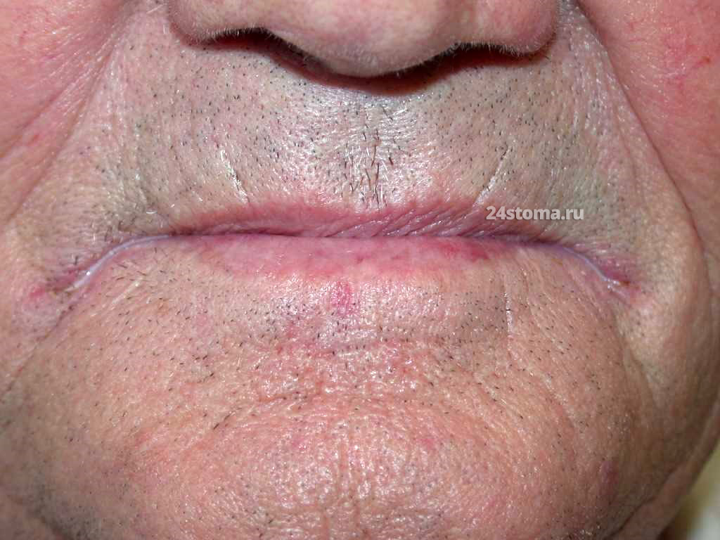 Кандидомикотические заеды в глубоких складках кожи - в углах рта