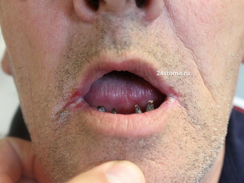 Заеды в углах рта (Candida + стрептококк)