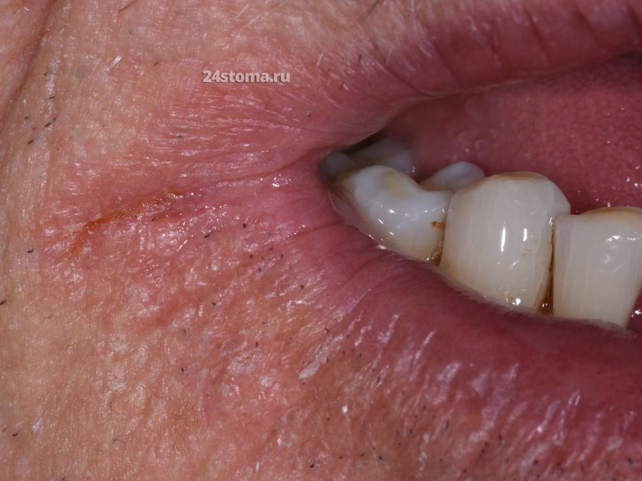 Трещины в уголках губ