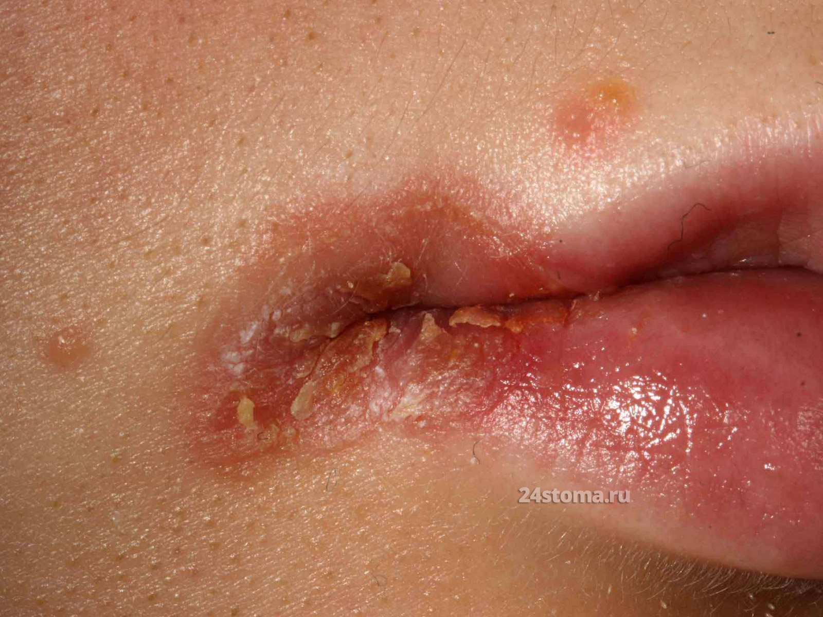 Инфицированные заеды в уголках губ у ребёнка