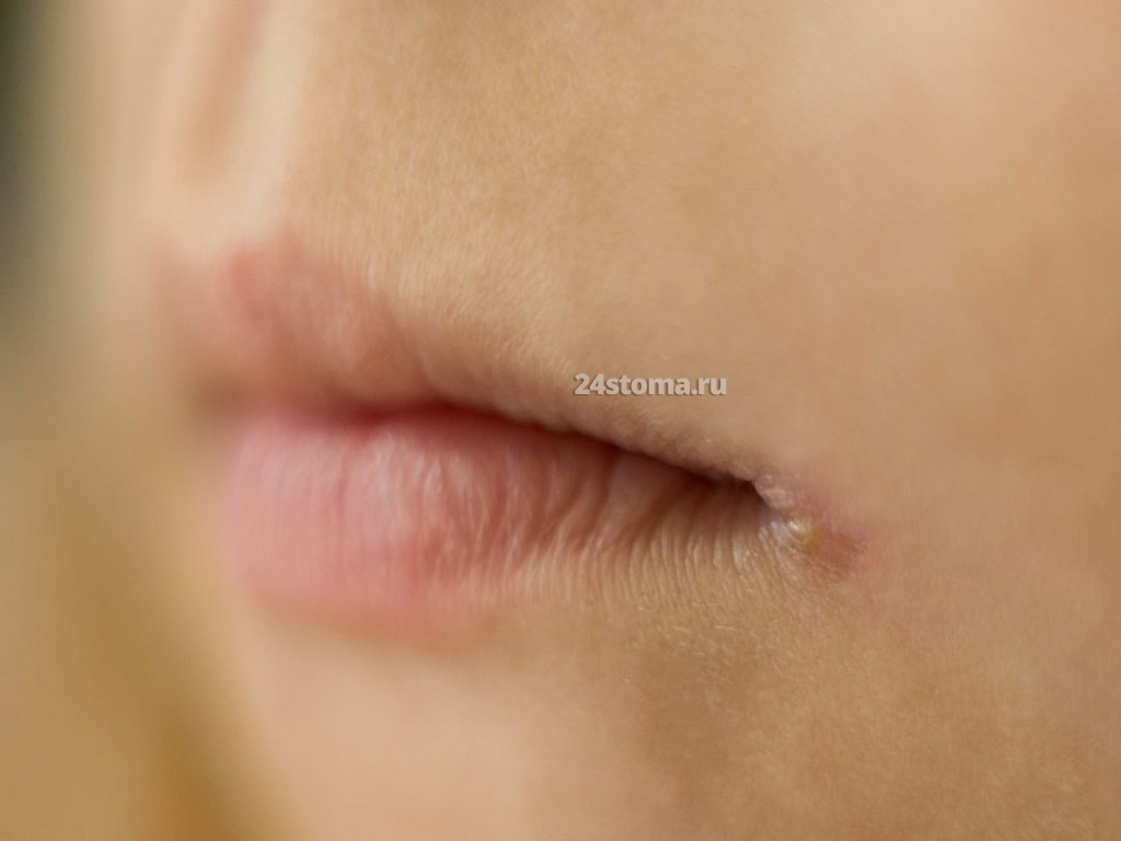 Стрептококковые заеды (образование пустулы в углу рта)