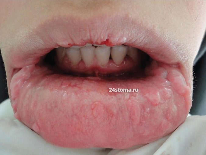 Очаговая эпителиальная гиперплазия на губах (болезнь Хека)