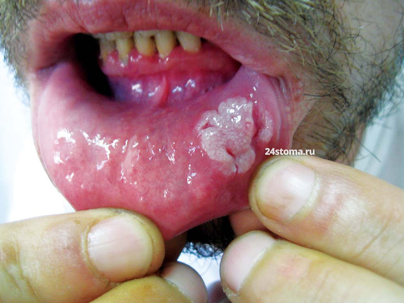 Широкая кондилома на слизистой оболочке губы (вторичный сифилис)