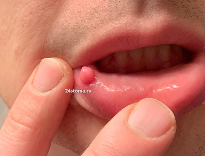 Травматическая фиброма на губе