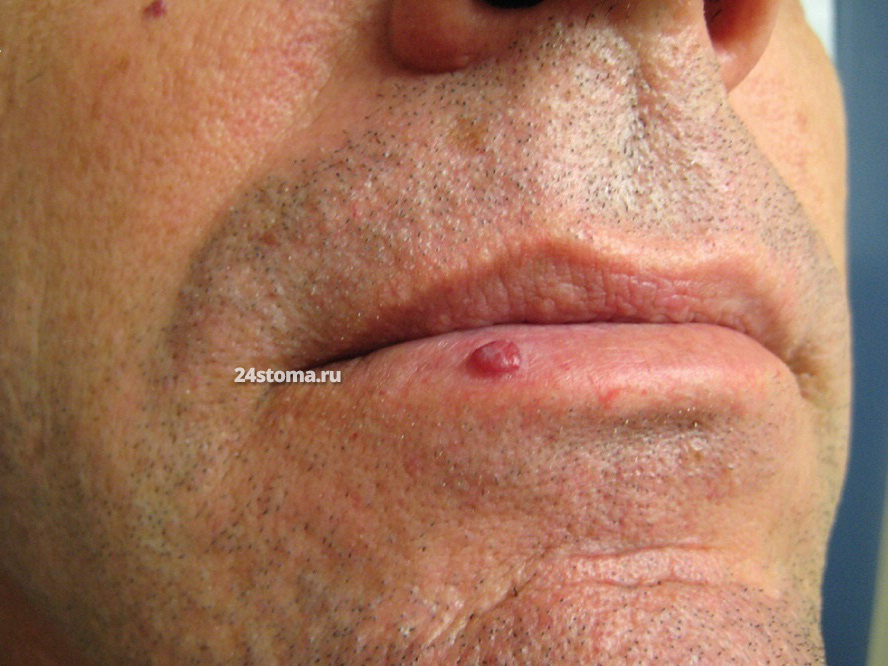 Пиогенная гранулема на нижней губе