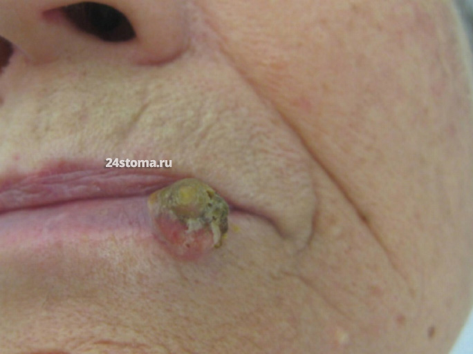 Кератоакантома на нижней губе