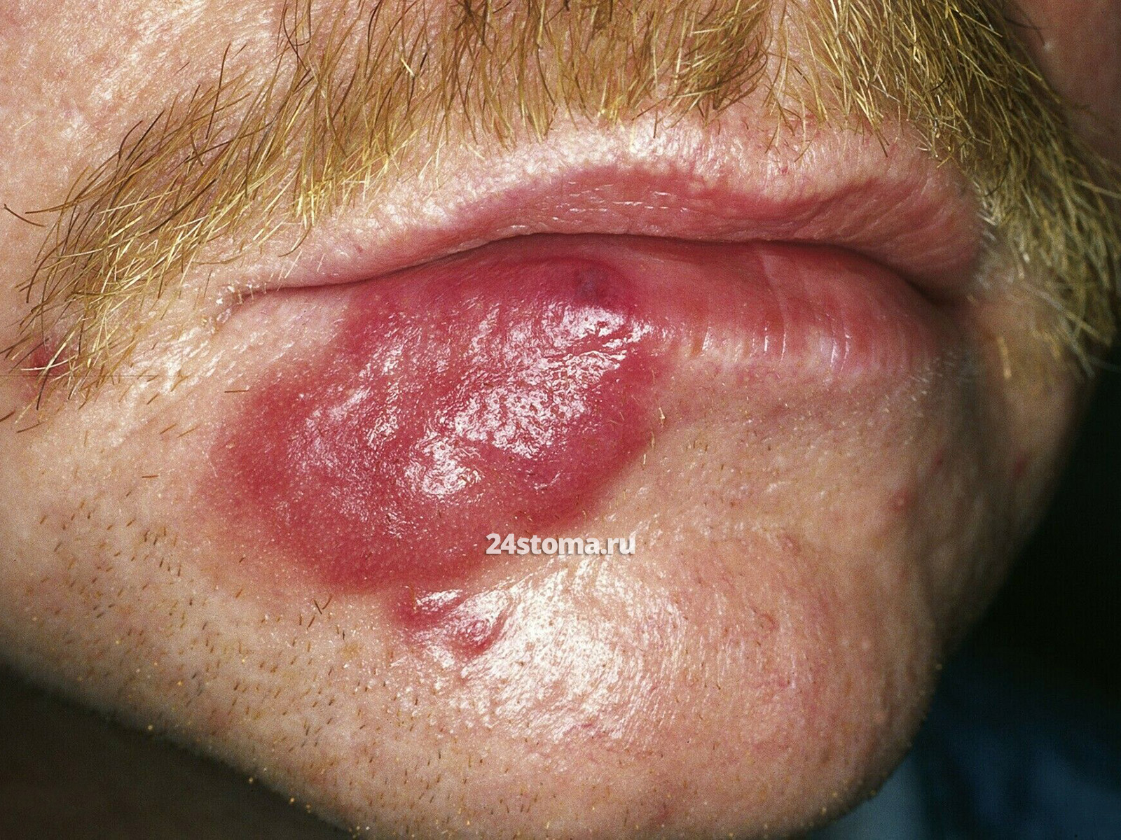 Первичная кожная анапластическая крупноклеточная лимфома